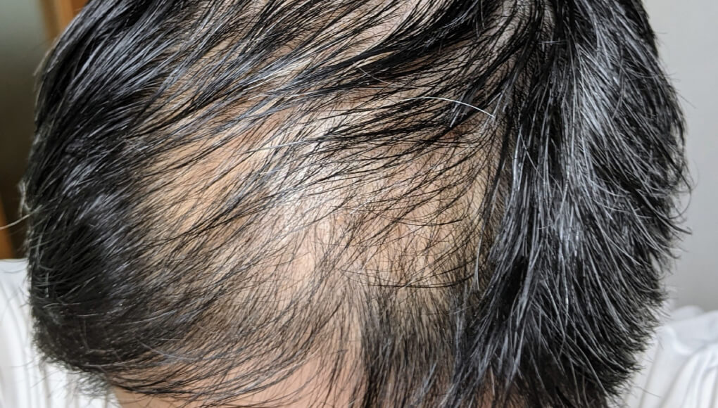 ハゲ散らかしている1