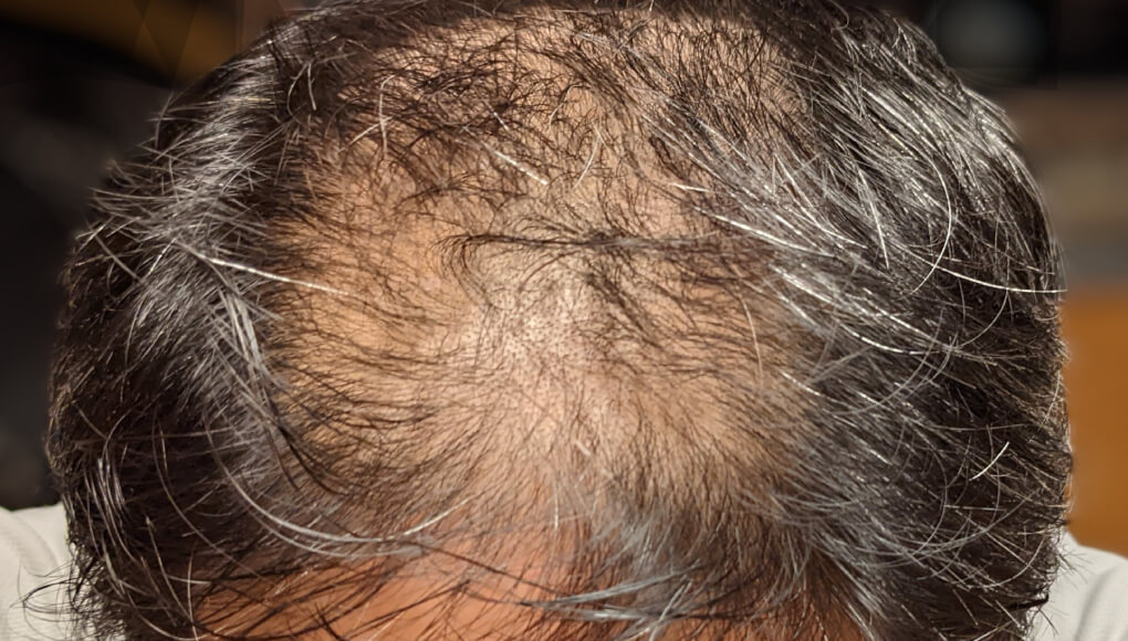 ハゲ散らかしている2