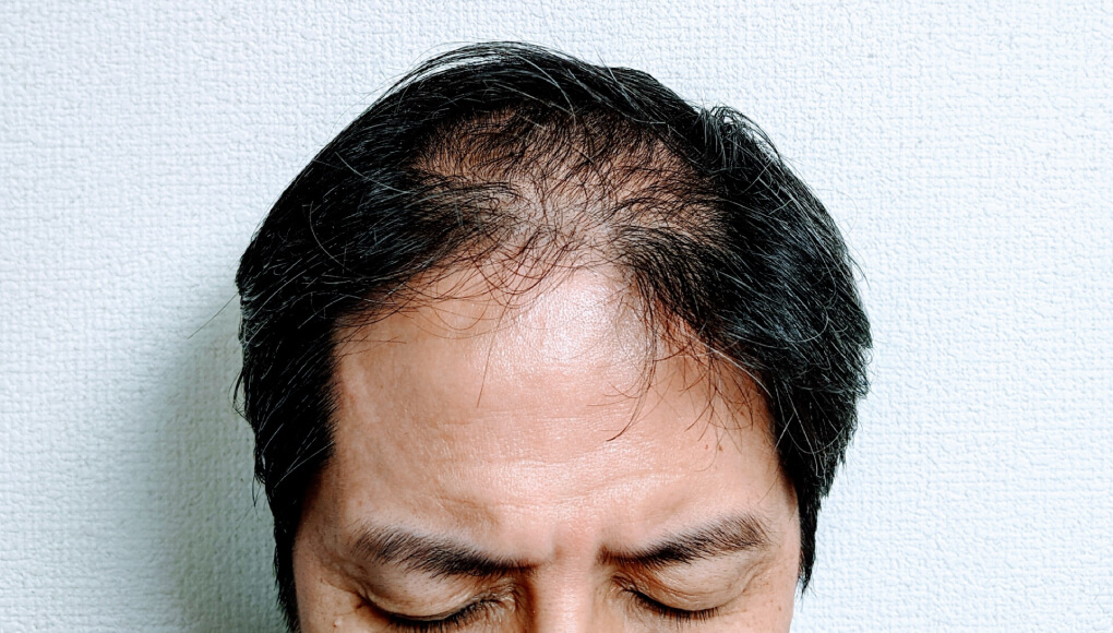 ハゲ散らかしている3