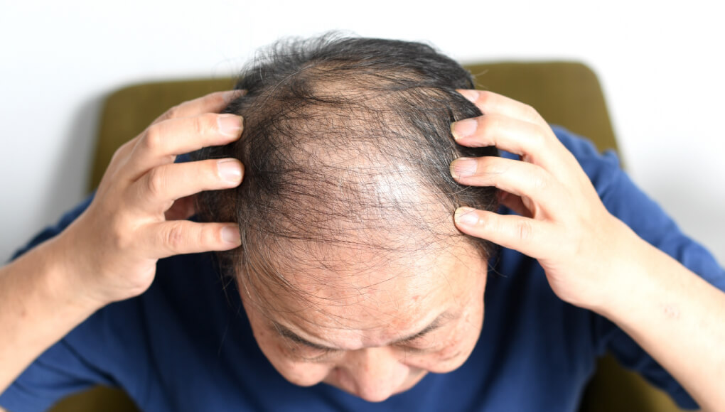 ハゲ散らかしている4