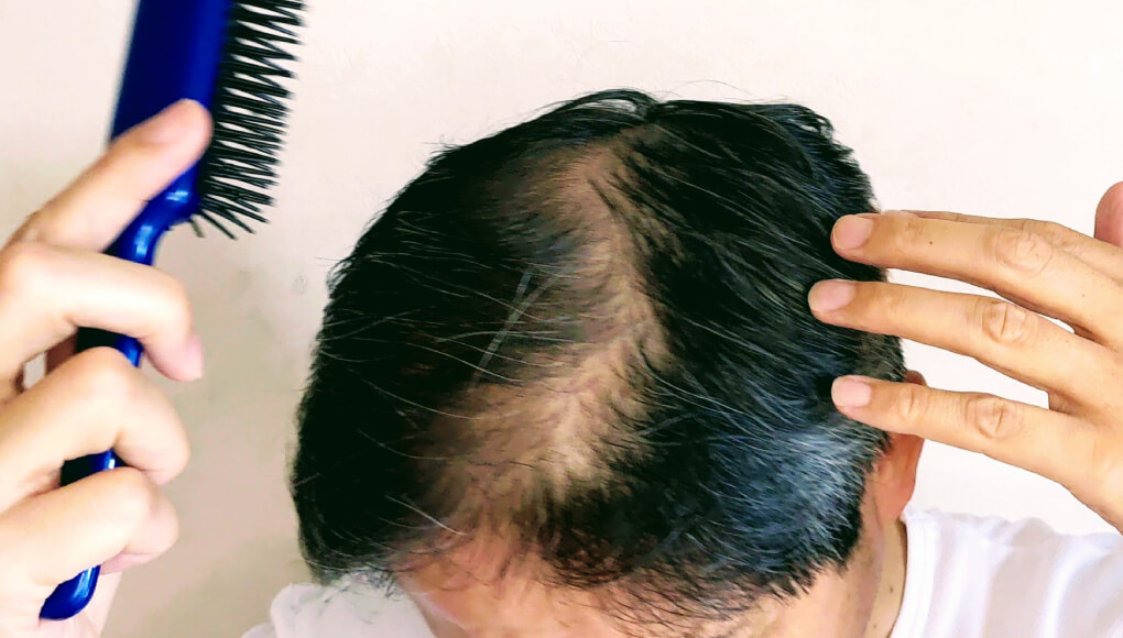 ハゲ散らかしている5